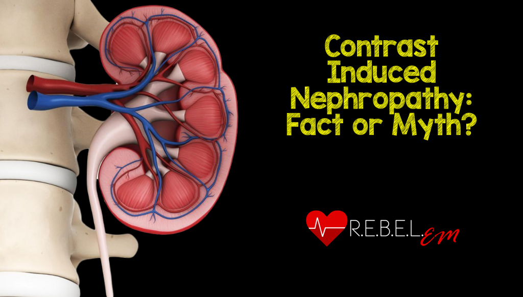 Contrast-Induced-Nephropathy-CIN-1024x583.png