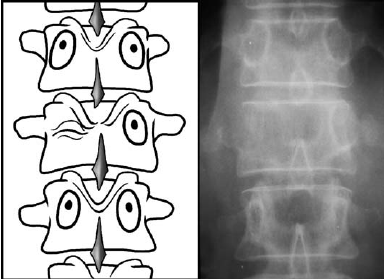 Pedicle-erosion-winking-owl-sign-the-most-common-plain-film-finding-in-patients-with.png