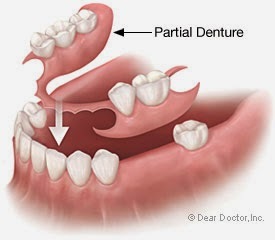 partial-denture2.jpg